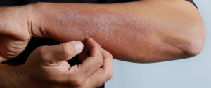 Atopowe zapalenie skóry - alergeny