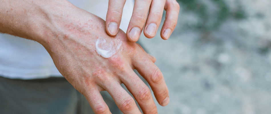 Atopowe zapalenie skóry odmiany i rodzaje