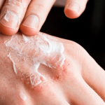 Krem na atopowe zapalenie skóry – który sprawdzi się najlepiej?